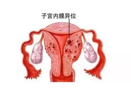 试管婴儿,子宫内膜异位症